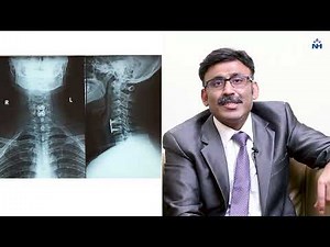 What is Cervical Disc Prolapse? Dr Naveen S. Tahasildar
