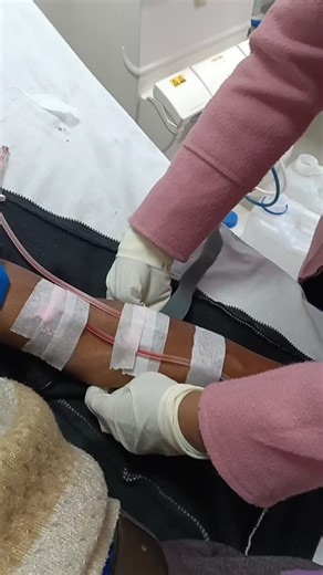 Aaysha_artistry on Instagram: "“AVF needle removal | Dialysis care 🩸” . . . #AVFcare #DialysisLife #DialysisTechnician #KidneyCare #AVFNeedle PatientCare HealthcareShorts MedicalAwareness"