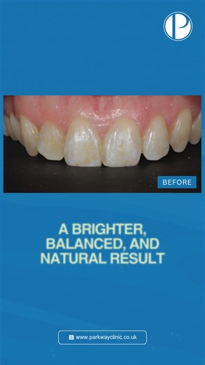 This patient wanted a brighter, more even smile with straighter teeth and a beautifully natural finish. Their treatment plan included: 🦷 Invisalign – to gently guide the teeth into their ideal positions ✨ Professional Whitening – to safely lift and brighten the overall shade 🎨 10 Composite Veneers – hand-sculpted to enhance shape, symmetry and colour for a seamless result The final smile looks refreshed, confident, and completely harmonious, a transformation that still feels true to the patien