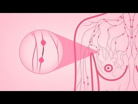 Beyond The Shock - Chapter 5 - Types & Stages - Inflammatory Breast Cancer