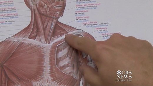 Bionic hands controlled with the brain