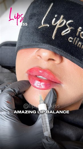 Russian lips 👄 #filler #beauty #lipsaugmentation #lipsfiller