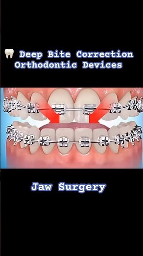 Deep Bite Correction by Braces + Jaw Surgery