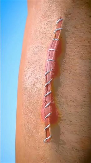 The Science of Healing: How Stitches Help Your Body Repair! 🩹🩸