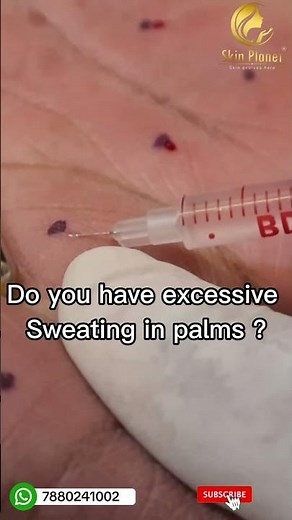 BOTOX TREATMENT FOR HYPERHIDROSIS (SWEATY HANDS) | SKIN PLANET |