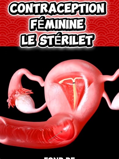 #operation #medecine #chirurgie #apprendre Le stérilet, ou DIU, c’est comme installer un système de sécurité permanent directement dans l'utérus pour empêcher une grossesse sans avoir à y penser tous les jours. C’est un tout petit objet en forme de T, pas plus grand qu'une allumette, qui se place au fond de la