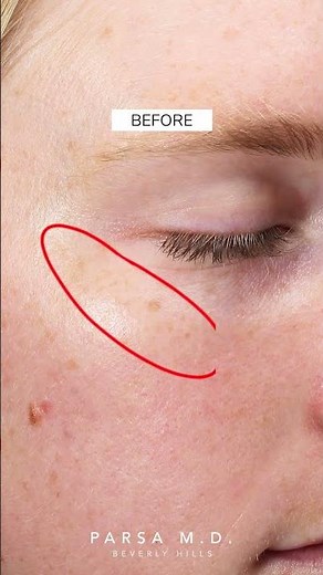 Before and After IPL Laser (LUMECCA)| Kami Parsa, M.D. | PARSA MD #skincare