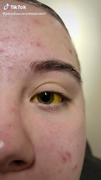 Uses and Benefits of Sodium Fluorescein for Eye Irritation and Dryness