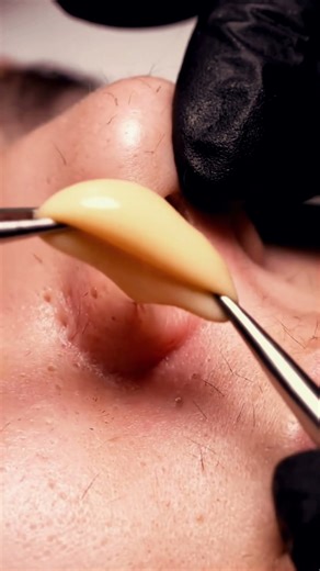Dermatologist Removes THIS From a Nose | Macro ASMR #4kmacro #satisfying #macroasmr