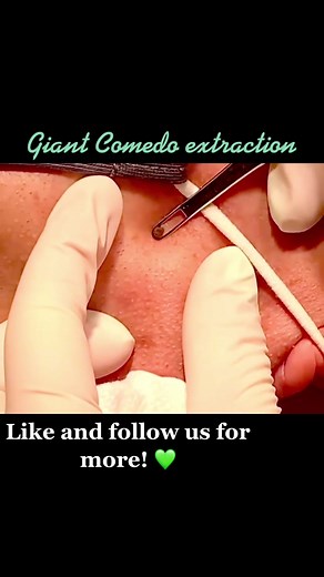 Another comedo extraction by Dr.Evans 💚 #pimplepop #extractions #skincare #acne #dermatology #skin #connecticut #selflove #skincaretips #selfcare