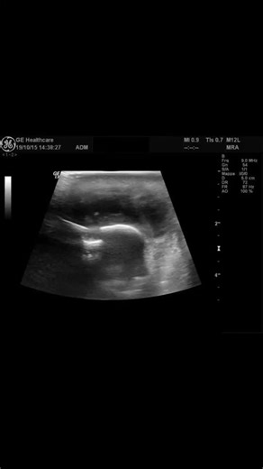 Radiology @all abnormalities 🥏🥏 on Instagram: "ULTRASOUND – LOCAL PARTS (CHIN / SUBMENTAL REGION) Clinical Presentation: Swelling over the chin without history of trauma. No fever. Associated complaint of lockjaw. Patient Data: Age: 42 years Gender: Male Findings: In the subcutaneous tissues over the chin, a well-defined fluid collection measuring approximately 4.0 cm in maximum dimension is seen, compatible with an abscess. Internal echoes are present within the collection. Surrounding soft t