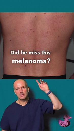 Did he miss a melanoma? #melanoma #melanomaawareness #dermatologist #dermatoscopy