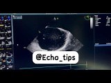 TEE Visualization of Atrial Septal Defect (ASD) • Video • MEDtube.net