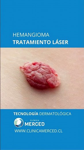 🔬 ¿Qué es un Hemangioma? ¡Conoce su Tratamiento Láser en Clínica Merced! 🔬
