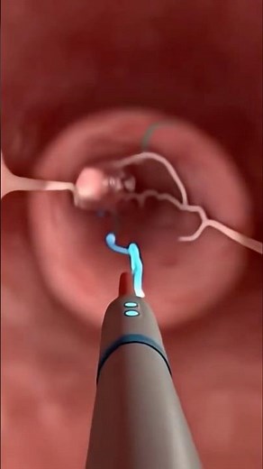 3D Animation of Sigmoid Colonoscopy Explained #shotrs