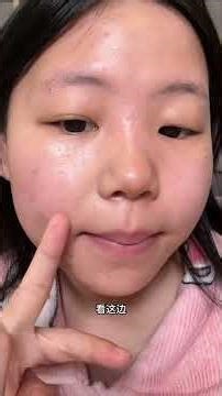 How to Get Rid of Nose and Cheek Redness, Acne, and Scars