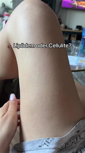 Understanding Lipödem and Cellulite Differences
