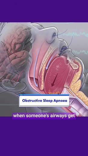 Understanding Obstructive Sleep Apnoea (OSA): Signs, Symptoms, Causes & Treatment