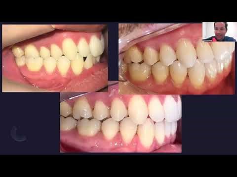 "Mordida Cruzada Corrigida com Invisalign: Antes e Depois de Transformar Sorrisos!"