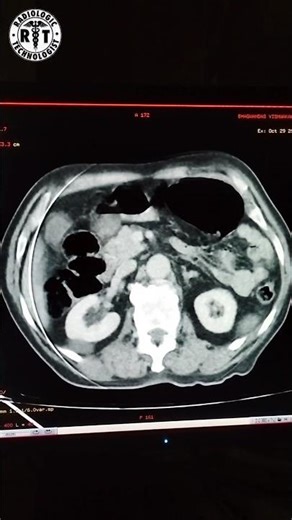 गंभीर साइनसाइटिस (Sinusitis) का CT☢️ दृश्य। 😷 जानें इसके लक्षण और पहचान। #ctscan #radiology #short