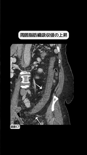 虚血性腸炎 #radiology #画像診断#shorts