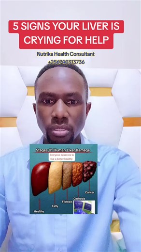 Here are 5 warning signs your liver needs help #liver #Cirrhosis #liverhealth #nutrika #linkinbio Your liver could be slowly failing right now… and you may not even know it. If you notice ANY of these 5 signs, your liver is crying for help! 🚨 Your liver is the detox center of your body. It cleans your blood, balances hormones, controls fat metabolism and protects you from toxins. But when the liver becomes weak or overloaded… your entire body begins to suffer. Here are 5 warning signs your live