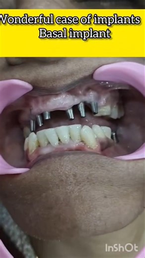 7 Din Mein New Teeth 😱🦷 | Basal Implants Magic!