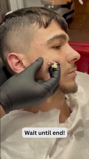 Large Blackheads Extraction Big Cystic Acne Blackheads&Whiteheads Removal Pimple Popping #1118 2026