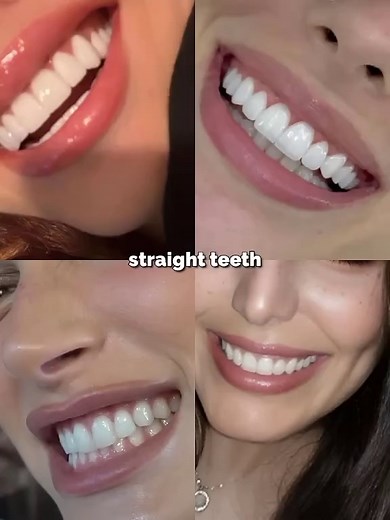 What Type of Teeth Do You Have? Discover Your Dental Style!