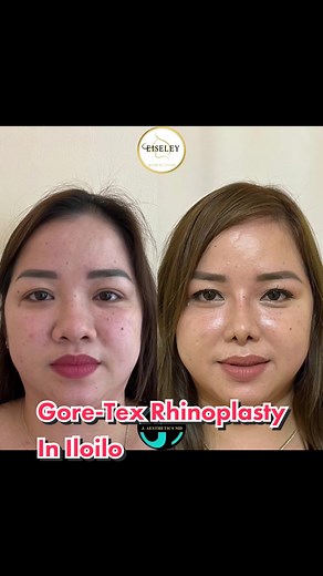 Gore-Tex Rhinoplasty with Tip Plasty using Ear Cartilage, and Alar Plasty. Follow me on Instagram @jaestheticsmd & @dr.jchristian Facebook J. Aesthetics MD Tiktok: Dr. J Christian #JAesthetics #JAestheticsMD #drjchristian #rhinoplasty #nosejob #goretexrhinoplasty #structuralrhinoplasty #tiplasty #alarplasty #nosejobcheck #EiseleyAestheticCenter #fyp