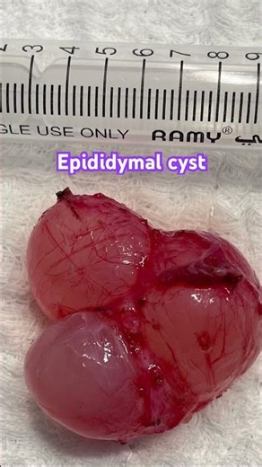Excised large #epididymal #cyst.