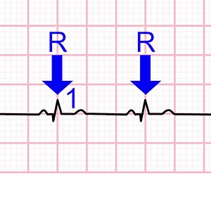 How to Calculate Heart-Rate from ECG - Learn more at https://acadoodle.com #emergencymedicine #intensivecare #respiratory #respiratorycare #icu #nurses #icunurse #ecg #ekg #cme #cmeonline | Acadoodle