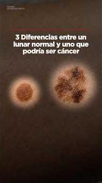 3 Differences Between a Normal Mole and One That Could Be Cancer