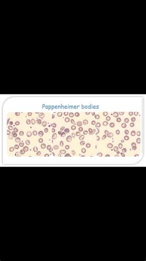 💐 Pappenheimer Bodies💐 💐 iron-containing granules present in the cytoplasm of red blood cells. They represent residual mitochondrial fragments or ferritin that have not been completely removed during erythrocyte maturation. 💐 Associated Conditions • Sideroblastic anemia • Post-splenectomy state or hyposplenism • Thalassemia • Myelodysplastic syndrome (MDS) • Iron overload or transfusion-dependent anemia 💐 How to Differentiate Basophilic Stippling from Pappenheimer Bodies 💐 ✅ Basophilic Sti