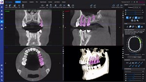 How to – Segment teeth in a CBCT image in Planmeca Romexis