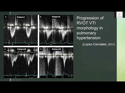 Evaluating RVOT (Right Ventricular Outflow Tract) With Ultrasound and Doppler