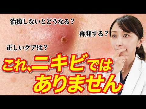 【これはニキビではありません】粉瘤の正しい対処法について皮膚科医が解説