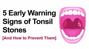 5 Early Warning Signs of Tonsil Stones (And How to Prevent Them)