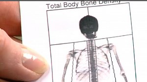 Check Your Health: Forget the scale, try a Dexa scan