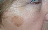 Images of Liver Spot Removal