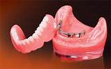 Images of Dental Implants Mission Viejo