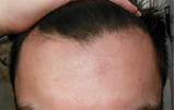 Temple Balding Treatment Images