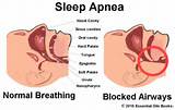 Photos of Central Sleep Apnea Home Remedies