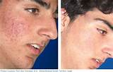 Laser Treatment To Remove Scars On Face Photos