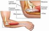 Pictures of Physical Therapy For Tennis Elbow Tendonitis