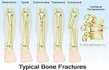 Medical Term For Bone Photos