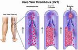 Pictures of Acute Deep Vein Thrombosis Treatment