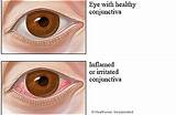 Medical Treatment For Pink Eye Photos
