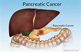 Home Remedies For Pancreatic Pain