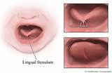 Frenectomy Recovery Images